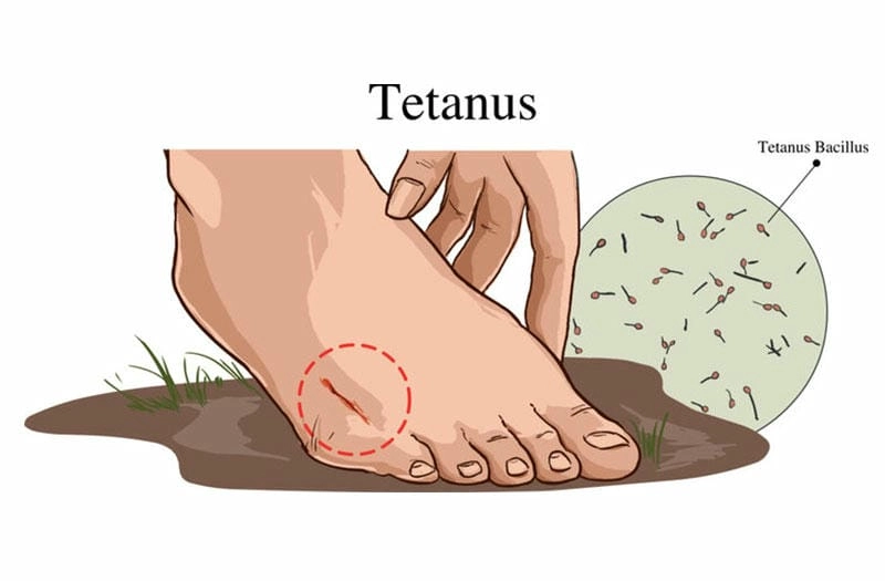 Tìm hiểu nguyên nhân gây bệnh uốn ván chính