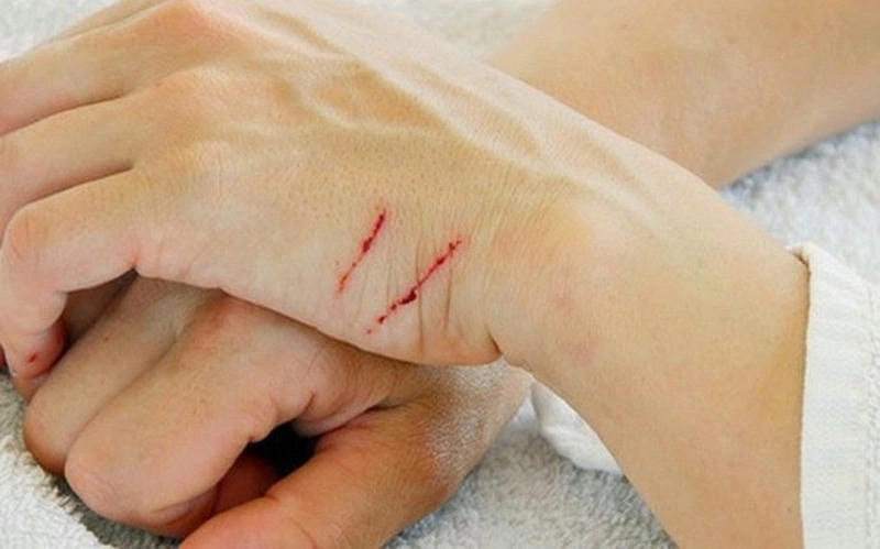 Nhận biết sớm bệnh uốn ván để điều trị kịp