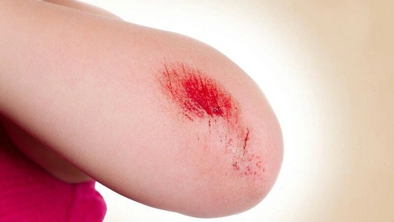 Tổng hợp bệnh uốn ván thể cục bộ bằng hình ảnh