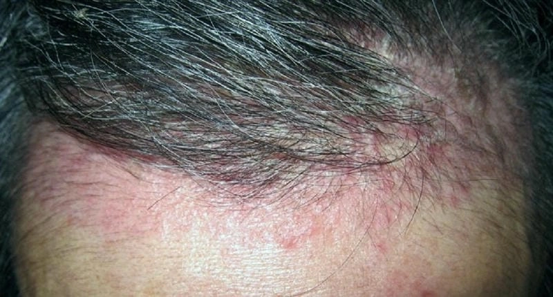 Trẻ bị vảy nến da đầu có thể bị ngứa dai dẳng
