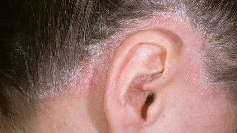 Da đầu có vảy lâu ngày có thể tiến triển xấu