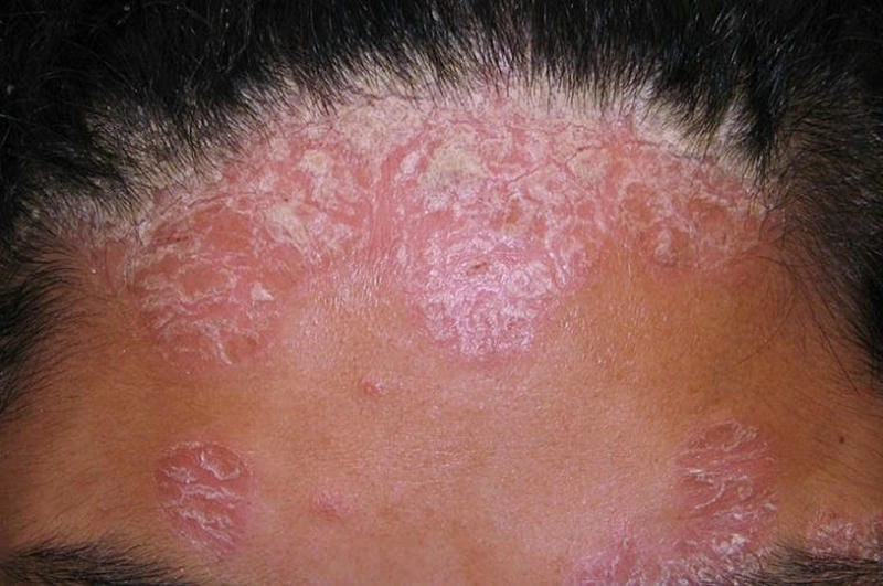 Dấu hiệu của bệnh vảy nến da đầu là mảng đỏ bong vảy