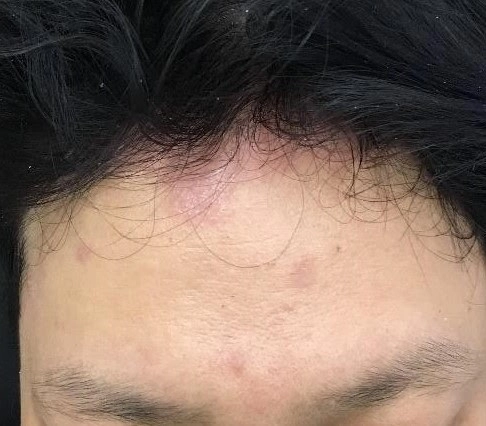 Vảy nến đầu có chữa được không là điều nhiều người quan tâm