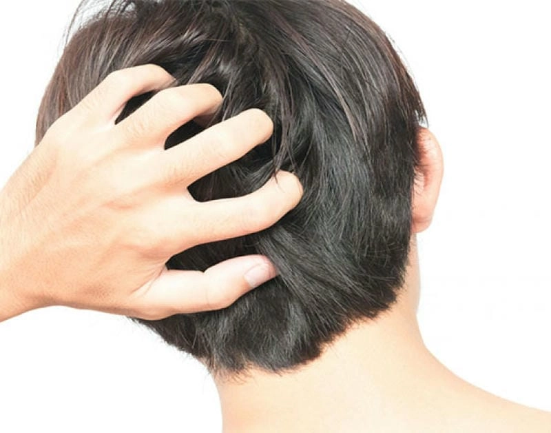 Nguyên nhân vảy nến da đầu có thể do di truyền