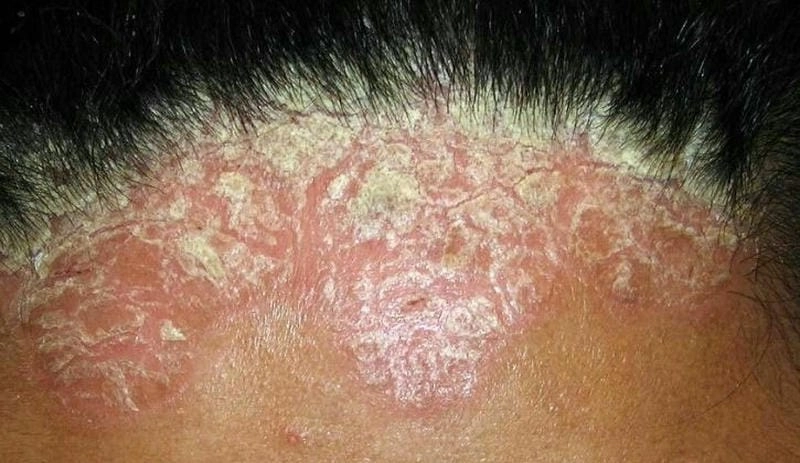 Vảy nến trên da đầu gây ngứa và bong tróc