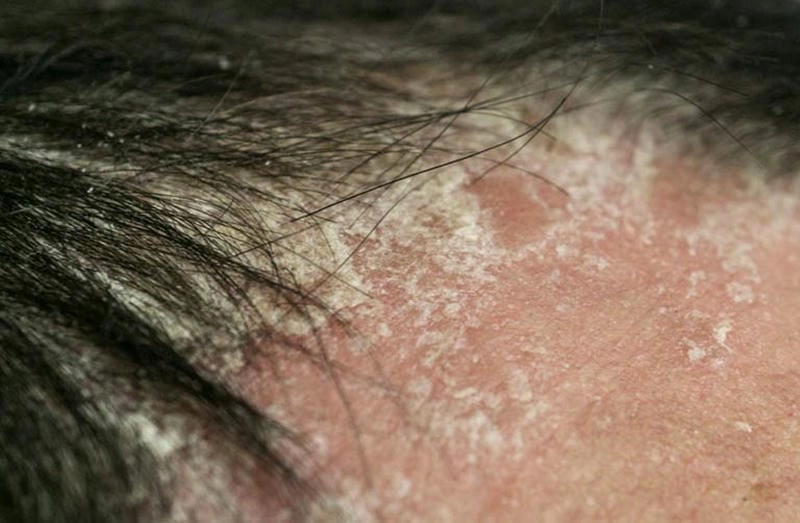 Vảy nến trên đầu thường nhầm với gàu nặng