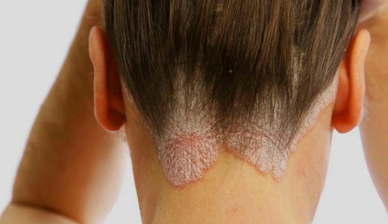 Vảy nến và nấm da đầu có triệu chứng giống nhau