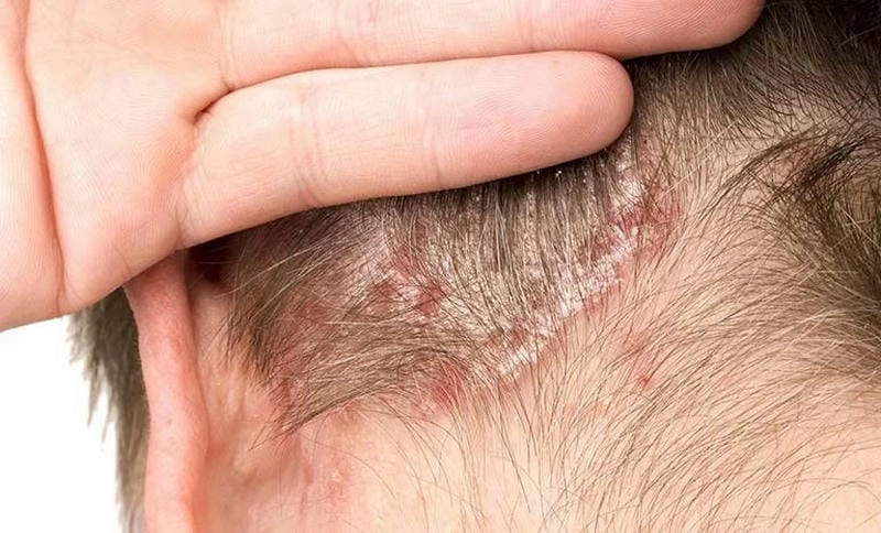 Ảnh người bị vảy nến da đầu cho thấy rõ mảng vảy