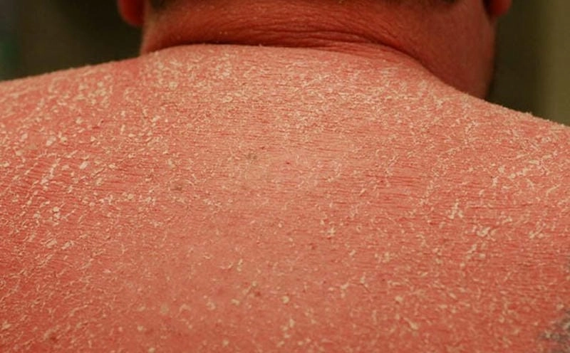 Dạng bệnh da vảy cá bẩm sinh phổ biến ở trẻ