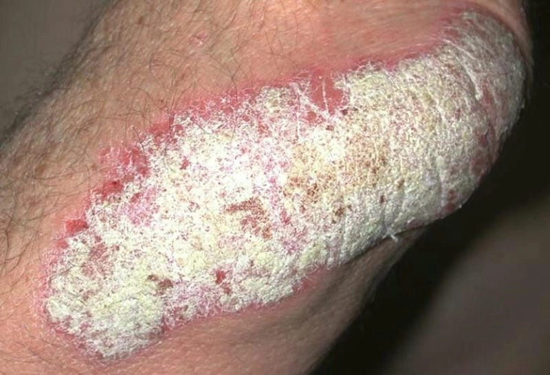 Cập nhật hình ảnh bệnh vẩy cá mới nhất