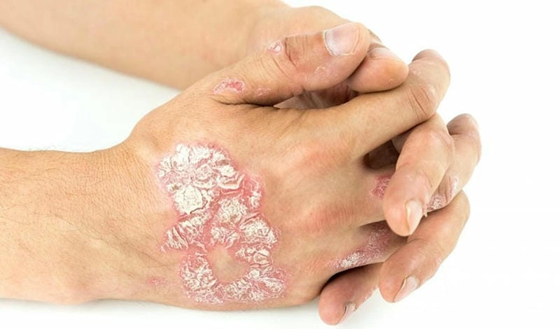 Tình trạng bị vảy cá ở chân cần lưu ý