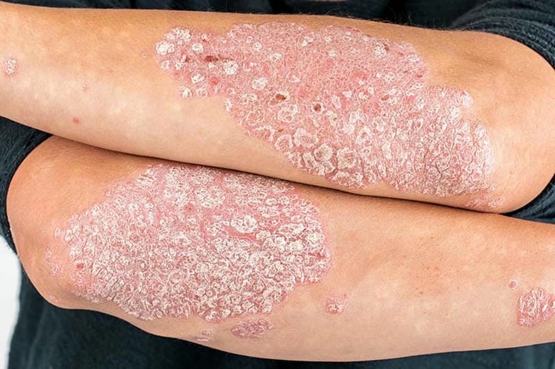 Tìm hiểu bệnh vảy cá bẩm sinh ở trẻ sơ sinh