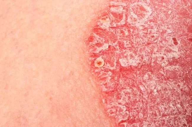 Quan sát thực tế da chân vảy cá qua ảnh