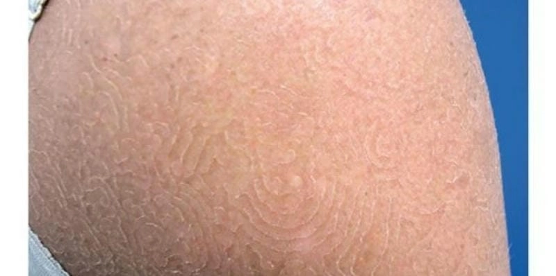 Chi tiết ảnh vảy cá bẩm sinh thường gặp