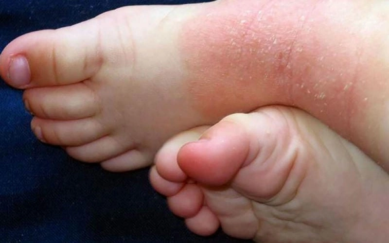 Cảnh báo sớm da vảy cá bẩm sinh từ nhỏ