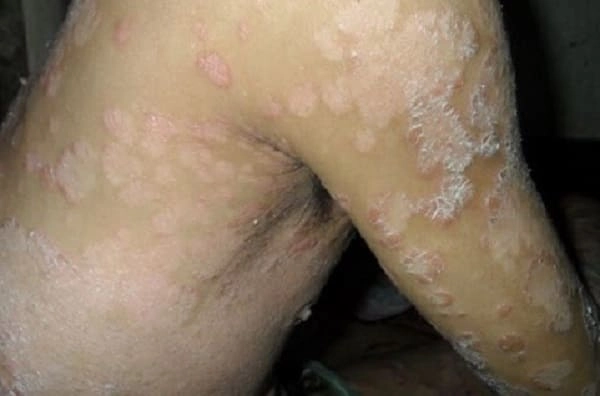 Dấu hiệu bệnh da vảy cá ở chân dễ nhận biết