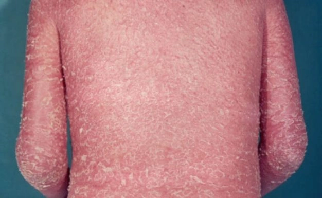 Thư viện hình ảnh bệnh vảy cá chi tiết nhất