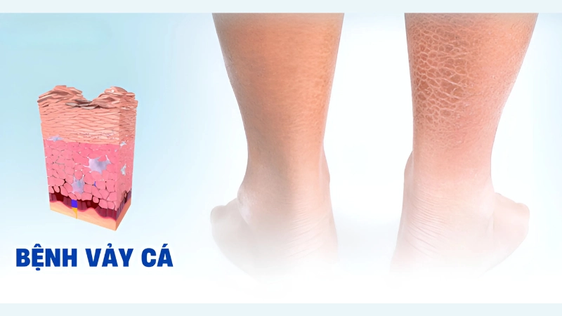 Hình ảnh bệnh vảy cá là như thế nào