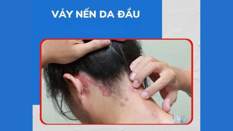 Hình ảnh bệnh vảy nến là như thế nào