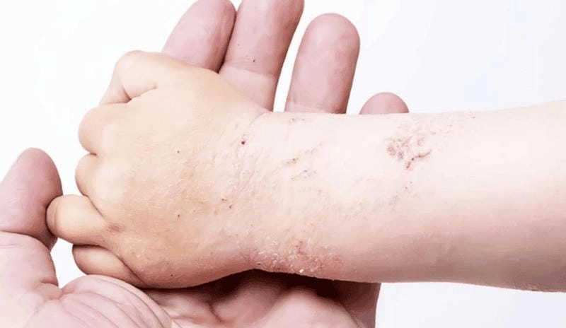 Cập nhật hình ảnh bệnh vảy nến phấn hồng ở người chi tiết