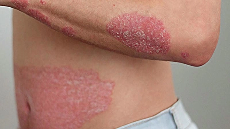 Các mức độ tổn thương vảy nến hồng