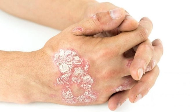 Tổng hợp mới nhất ảnh bệnh vảy nến phấn hồng