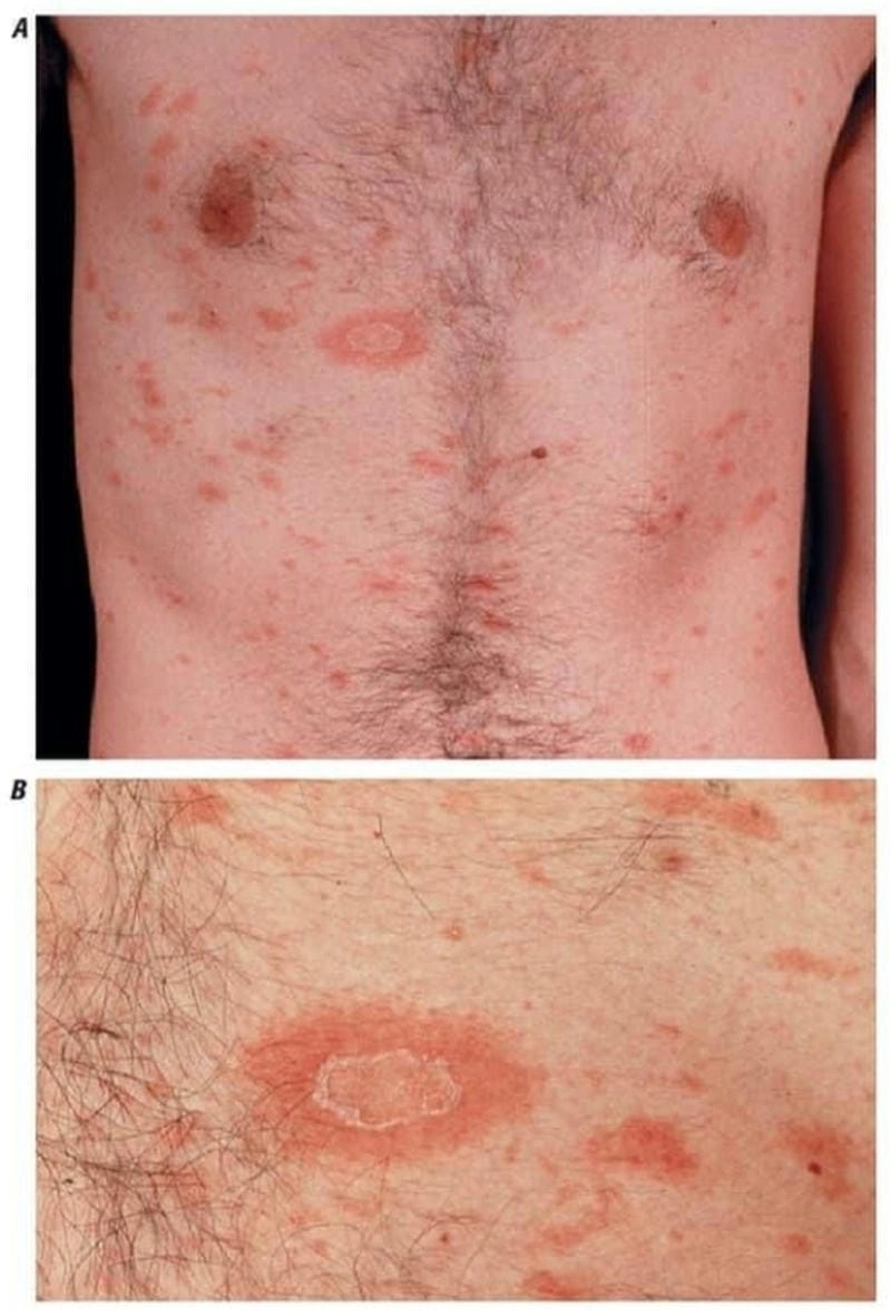 Phân biệt vảy nến hồng với eczema