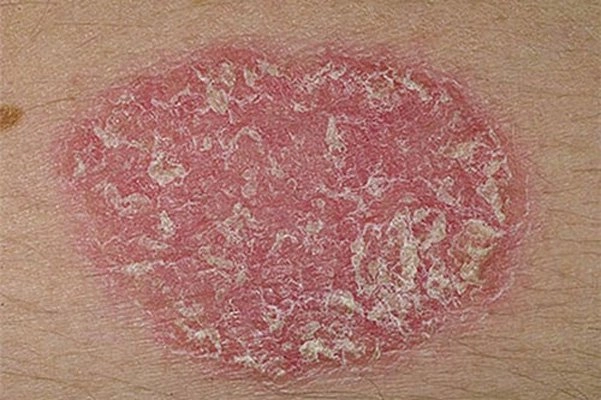 Giải đáp vảy nến hồng có lây không cho bạn