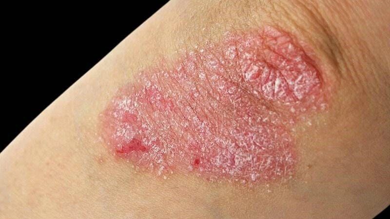 Biến chứng thường gặp vẩy nến hồng