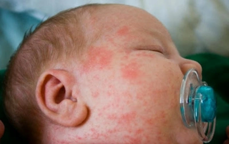 So sánh vảy phấn hồng và vảy nến dễ hiểu