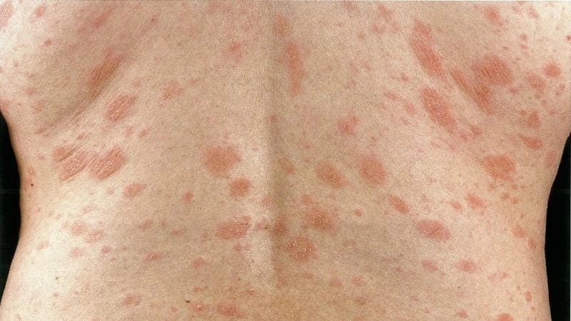 Dấu hiệu nhận biết vẩy nến hồng phổ biến