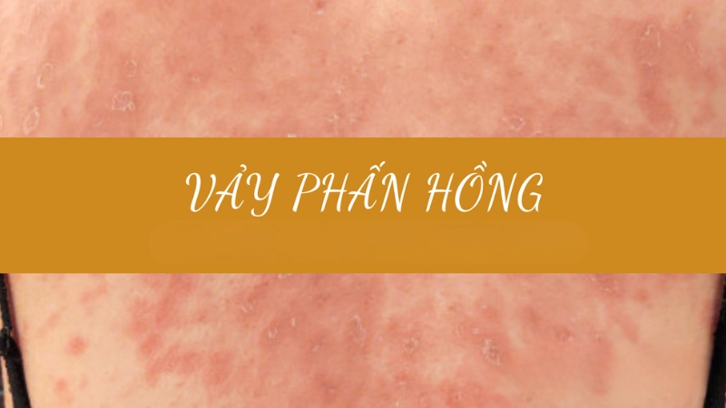 Hình ảnh bệnh vảy phấn hồng trông như thế nào