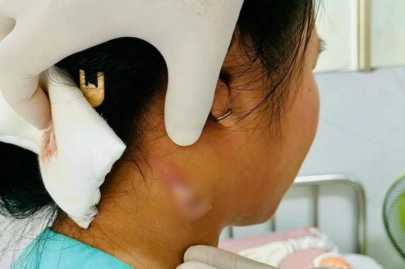 Nhận biết sớm vi khẩn ăn thịt người để xử lý kịp thời