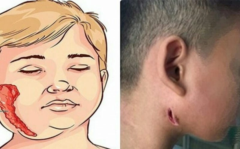 Tìm hiểu hình ảnh bệnh vi khuẩn an thịt người chân thực