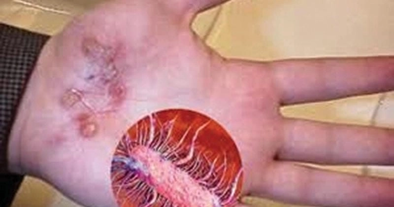 Nhận diện hình ảnh vi khuẩn ăn thịt người rõ nét