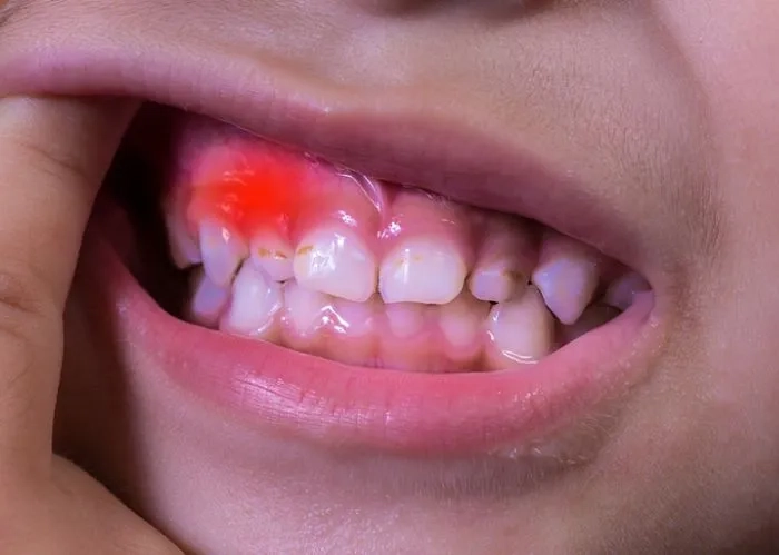 Tình trạng nặng của viêm nướu răng cấp tính