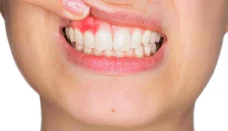 Xem ảnh thật về viêm nướu răng phổ biến