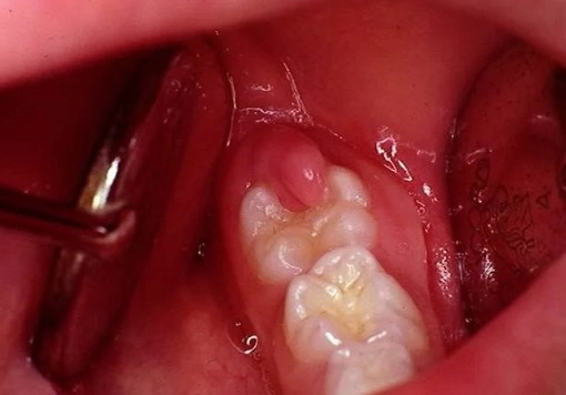 Cảnh báo sớm triệu chứng viêm nướu răng