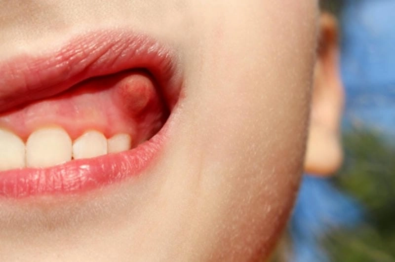 Bố mẹ nên xem hình ảnh viêm nướu răng ở trẻ