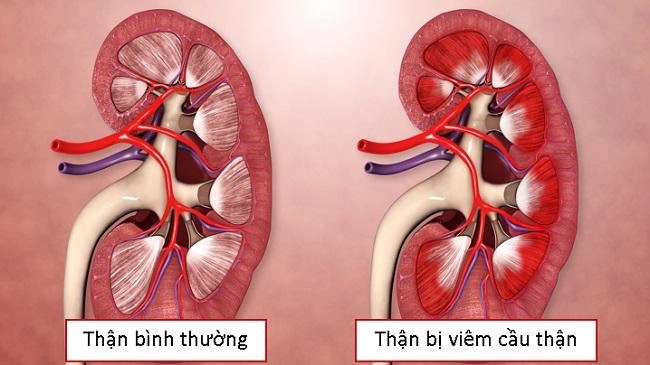 Giải đáp hình ảnh bệnh viêm cầu thận liệu có nguy hiểm không