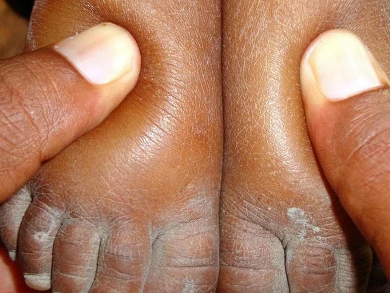 Tổng hợp hình ảnh bệnh viêm cầu thận qua ảnh minh họa