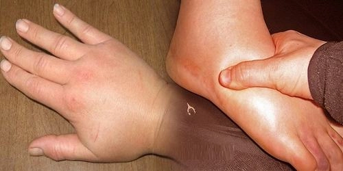 Tìm hiểu hình ảnh bệnh viêm cầu thận ở giai đoạn cấp tính