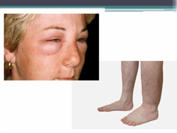 Hiểu rõ hình ảnh bệnh viêm cầu thận cấp hậu nhiễm thực tế