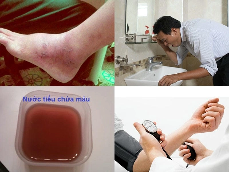 Khám phá hình ảnh bệnh viêm cầu thận qua bệnh học chuẩn