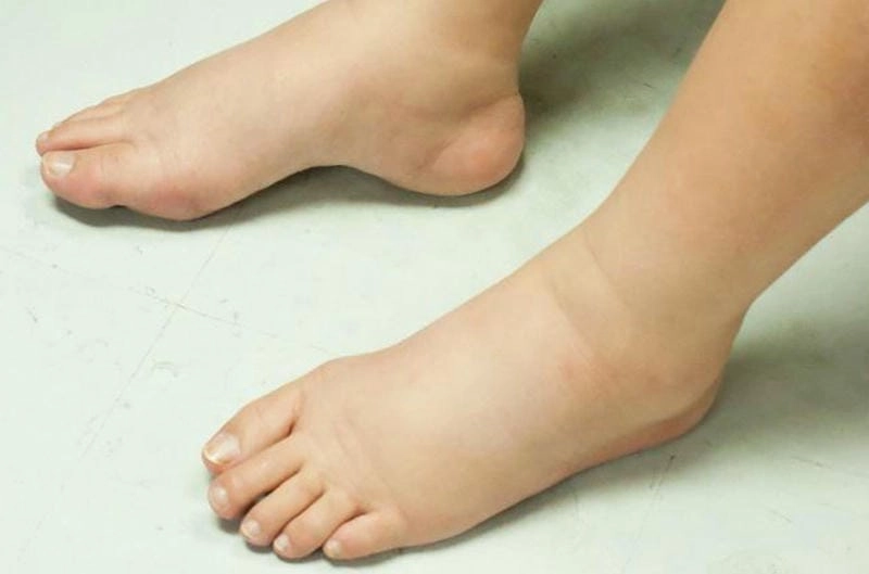 Hiểu rõ hình ảnh bệnh viêm cầu thận và các dấu hiệu điển hình