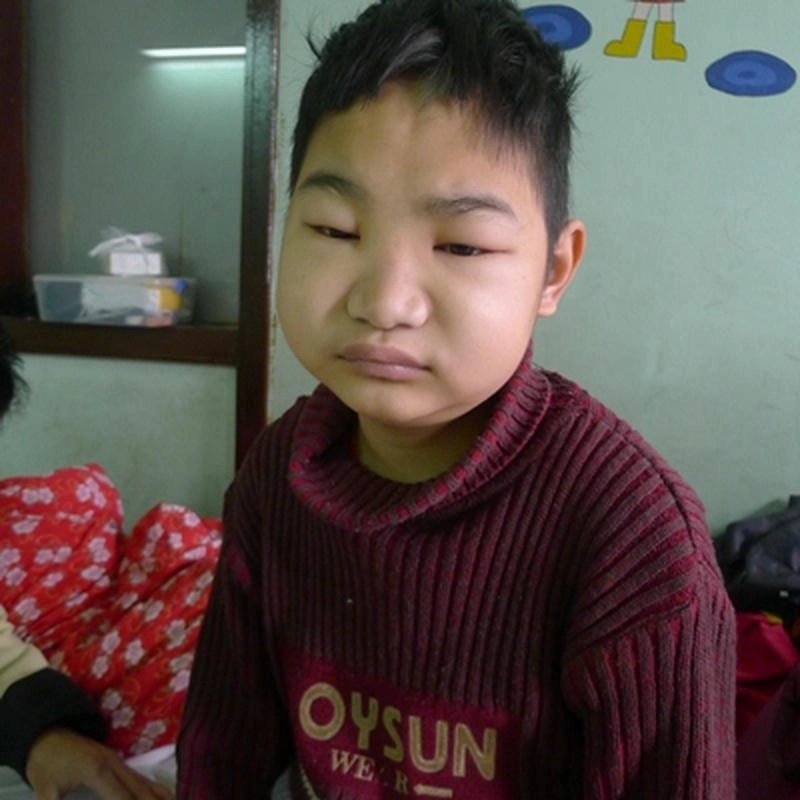 Nhận biết hình ảnh bệnh viêm cầu thận do nguyên nhân cấp