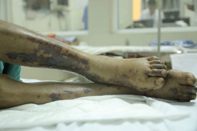 Khám phá hình ảnh bệnh viêm cầu thận và nguyên nhân gây bệnh