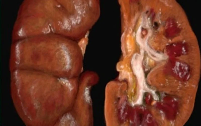 Hiểu rõ hình ảnh bệnh viêm cầu thận thường gặp ở người lớn