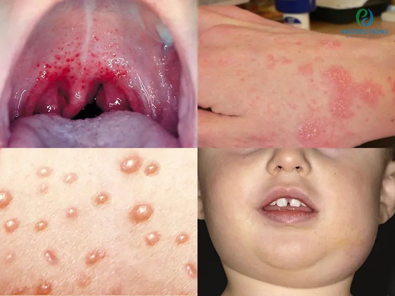 Tìm hiểu hình ảnh bệnh viêm cầu thận và các biến chứng nguy hiểm