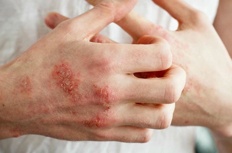 Bệnh viêm da cơ địa ở người lớn cần chăm sóc da đúng cách mỗi ngày